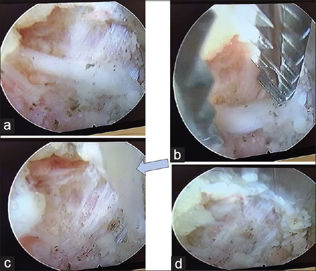 (a-d) Intraop pics of transverse process of right side, head towards left. Midline is up